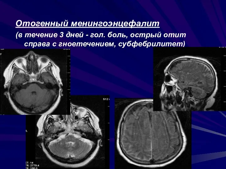 Отогенный менингоэнцефалит (в течение 3 дней - гол. боль, острый отит справа с гноетечением, субфебрилитет)