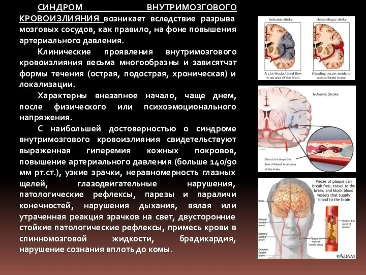 СИНДРОМ ВНУТРИМОЗГОВОГО КРОВОИЗЛИЯНИЯ возникает вследствие разрыва мозговых сосудов, как правило, на