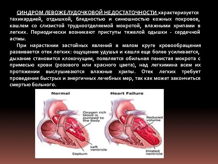 СИНДРОМ ЛЕВОЖЕЛУДОЧКОВОЙ НЕДОСТАТОЧНОСТИ характеризуется тахикардией, отдышкой, бледностью и синюшностью кожных покровов,