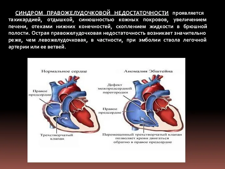 СИНДРОМ ПРАВОЖЕЛУДОЧКОВОЙ НЕДОСТАТОЧНОСТИ проявляется тахикардией, отдышкой, синюшностью кожных покровов, увеличением печени,