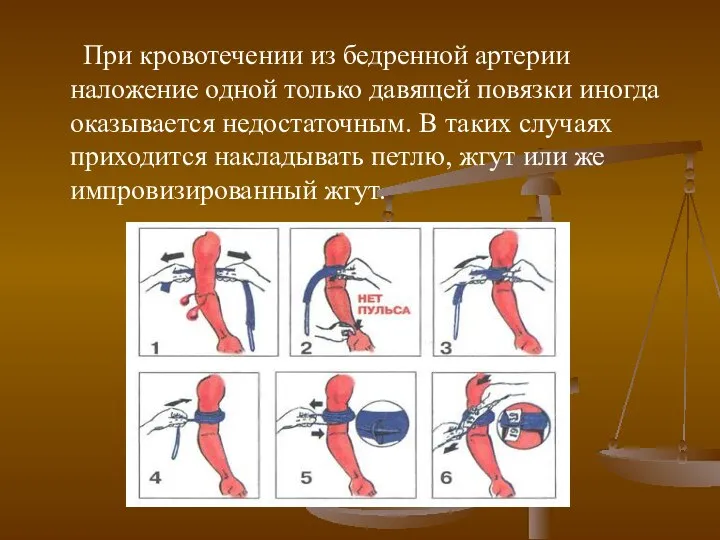 При кровотечении из бедренной артерии наложение одной только давящей повязки иногда