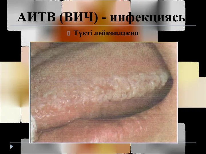 АИТВ (ВИЧ) - инфекциясы Түкті лейкоплакия