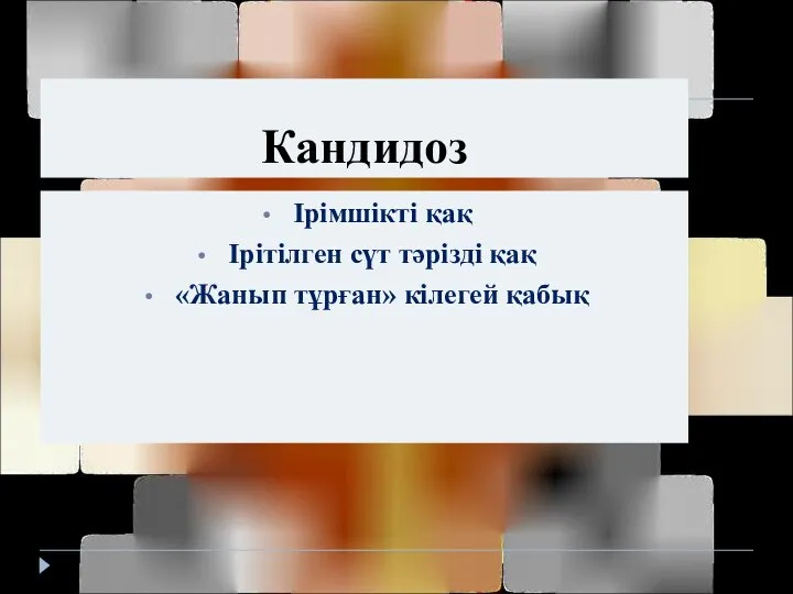 Кандидоз Ірімшікті қақ Ірітілген сүт тәрізді қақ «Жанып тұрған» кілегей қабық