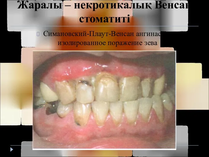 Жаралы – некротикалық Венсан стоматиті Симановский-Плаут-Венсан ангинасы – изолированное поражение зева