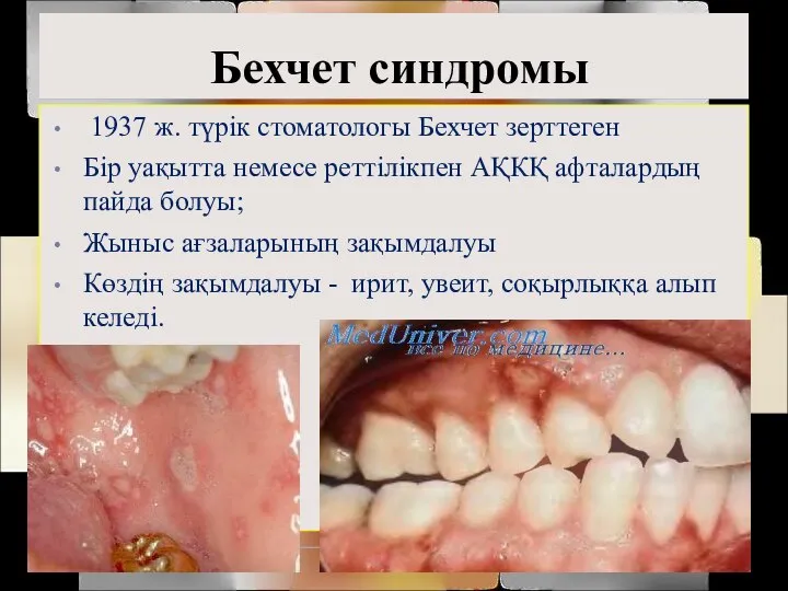 Бехчет синдромы 1937 ж. түрік стоматологы Бехчет зерттеген Бір уақытта немесе