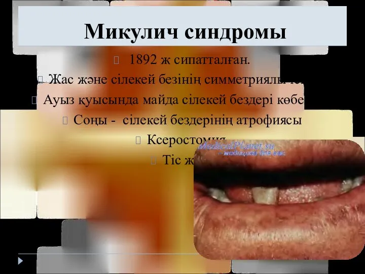 Микулич синдромы 1892 ж сипатталған. Жас және сілекей безінің симметриялы ісінуі;