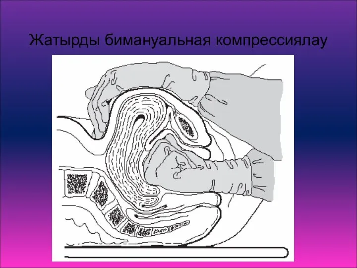 Жатырды бимануальная компрессиялау