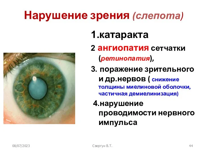 08/07/2023 Свергун В.Т. Нарушение зрения (слепота) 1.катаракта 2 ангиопатия сетчатки (ретинопатия),