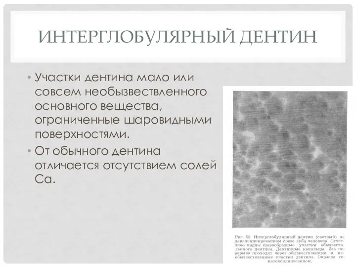 ИНТЕРГЛОБУЛЯРНЫЙ ДЕНТИН Участки дентина мало или совсем необызвествленного основного вещества, ограниченные