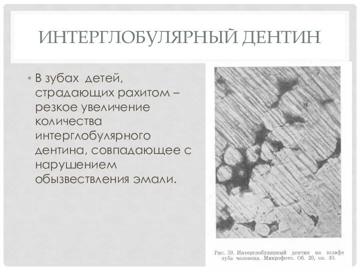 ИНТЕРГЛОБУЛЯРНЫЙ ДЕНТИН В зубах детей, страдающих рахитом – резкое увеличение количества