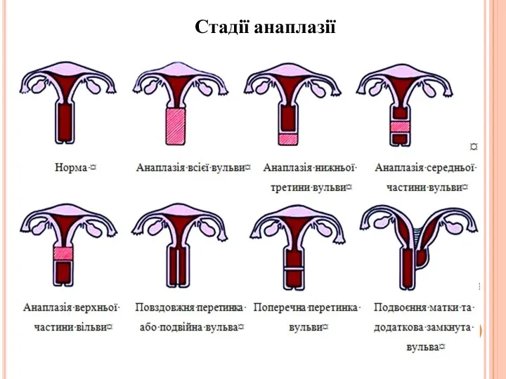 Стадії анаплазії