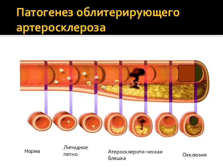 Патогенез облитерирующего артеросклероза Норма Липидное пятно Атеросклероти-ческая бляшка Окклюзия