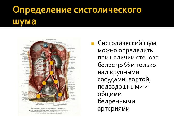 Определение систолического шума Систолический шум можно определить при наличии стеноза более