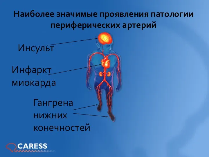 Наиболее значимые проявления патологии периферических артерий Инсульт Инфаркт миокарда Гангрена нижних конечностей