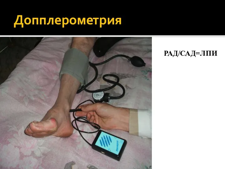 Допплерометрия РАД/САД=ЛПИ