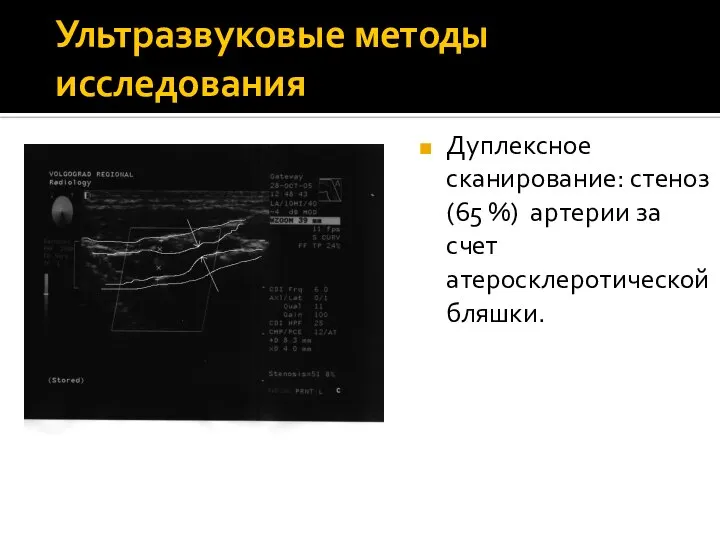 Ультразвуковые методы исследования Дуплексное сканирование: стеноз (65 %) артерии за счет атеросклеротической бляшки.