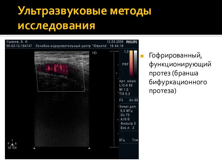 Ультразвуковые методы исследования Гофрированный, функционирующий протез (бранша бифуркационного протеза)