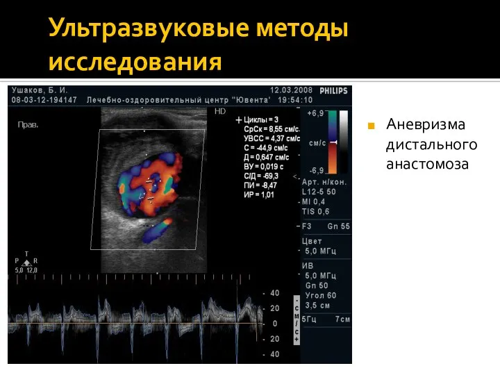 Ультразвуковые методы исследования Аневризма дистального анастомоза