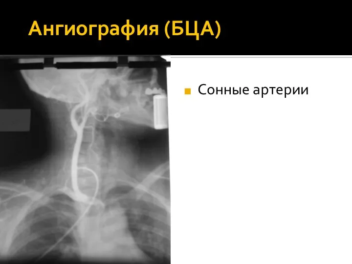 Ангиография (БЦА) Сонные артерии