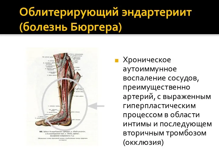 Облитерирующий эндартериит (болезнь Бюргера) Хроническое аутоиммунное воспаление сосудов, преимущественно артерий, с