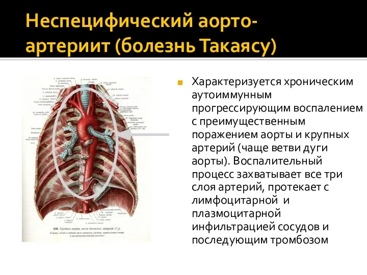 Неспецифический аорто-артериит (болезнь Такаясу) Характеризуется хроническим аутоиммунным прогрессирующим воспалением с преимущественным