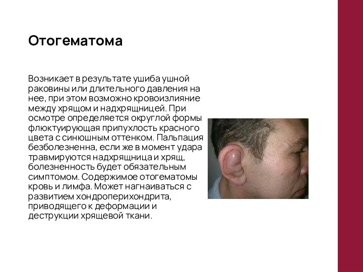 Отогематома Возникает в результате ушиба ушной раковины или длительного давления на
