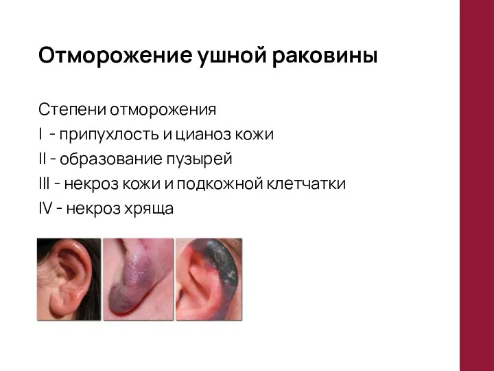 Отморожение ушной раковины Степени отморожения I - припухлость и цианоз кожи