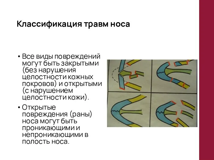 Классификация травм носа Все виды повреждений могут быть закрытыми (без нарушения