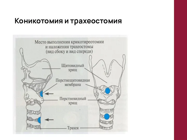 Коникотомия и трахеостомия