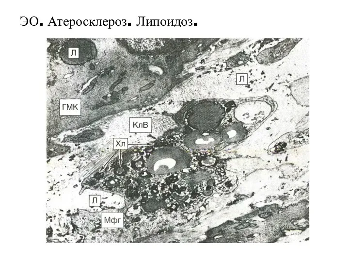 ЭО. Атеросклероз. Липоидоз.