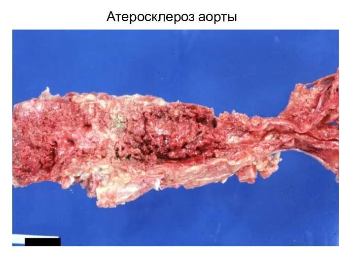 Атеросклероз аорты