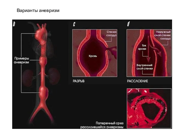 Варианты аневризм