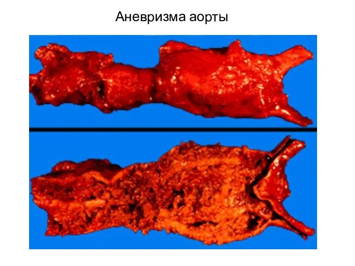 Аневризма аорты