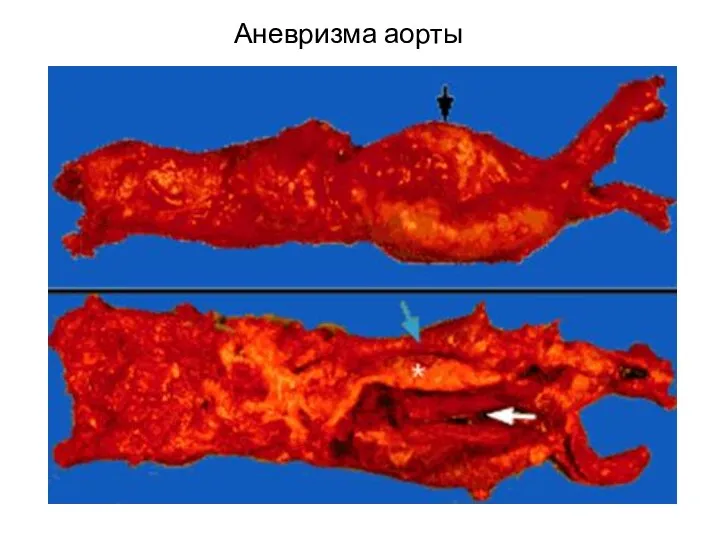 Аневризма аорты