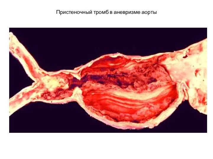 Пристеночный тромб в аневризме аорты