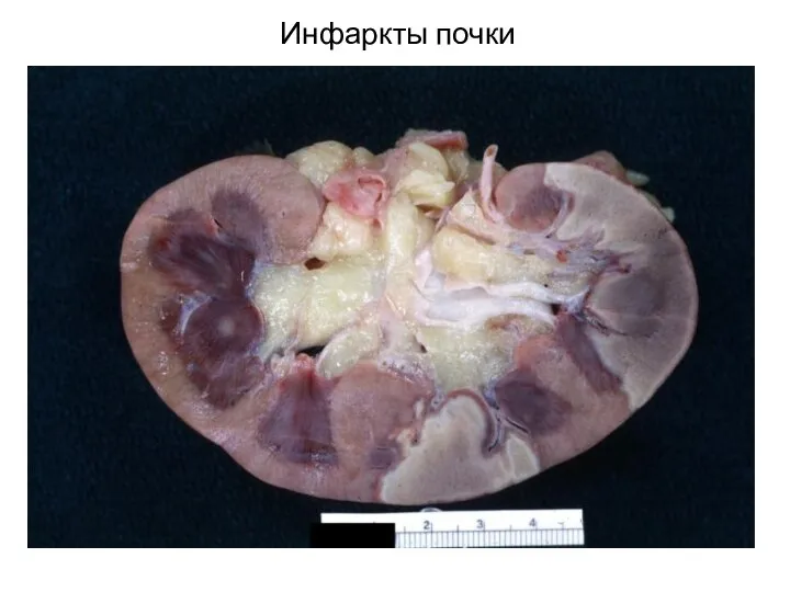 Инфаркты почки