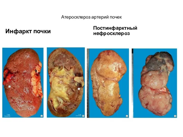 Атеросклероз артерий почек Инфаркт почки Постинфарктный нефросклероз