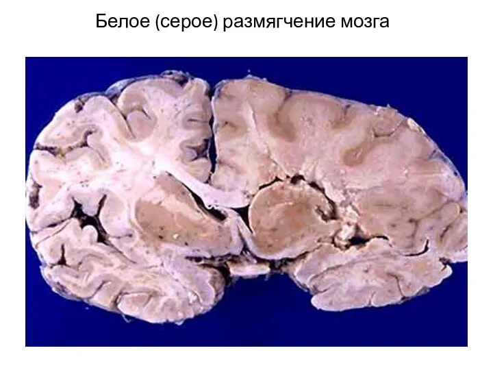 Белое (серое) размягчение мозга