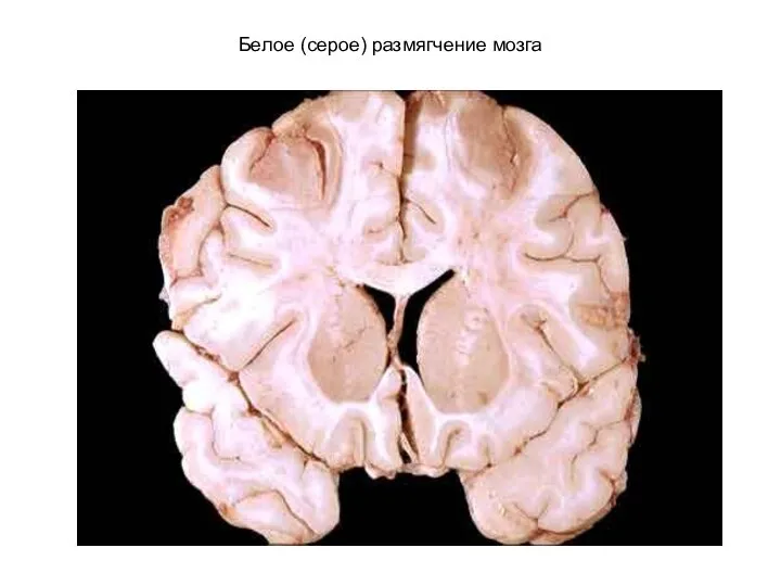 Белое (серое) размягчение мозга