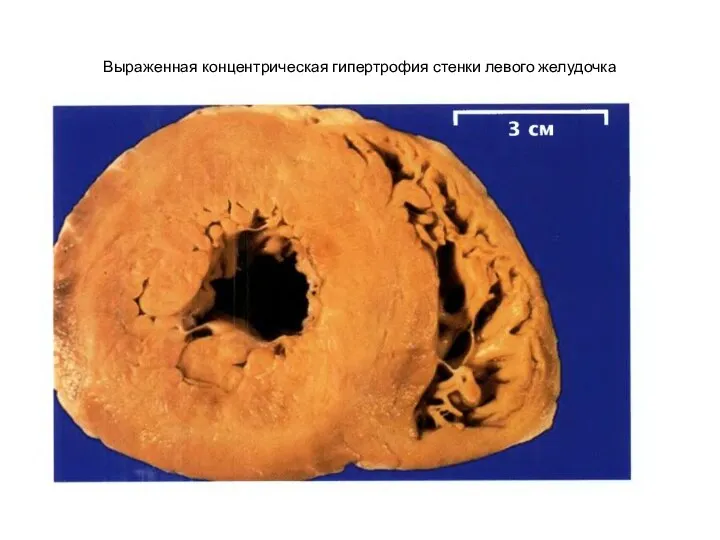 Выраженная концентрическая гипертрофия стенки левого желудочка