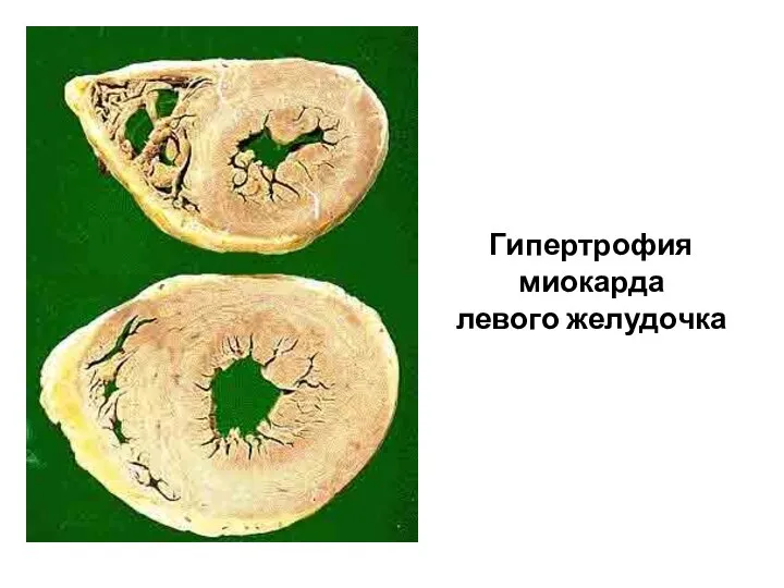 Гипертрофия миокарда левого желудочка