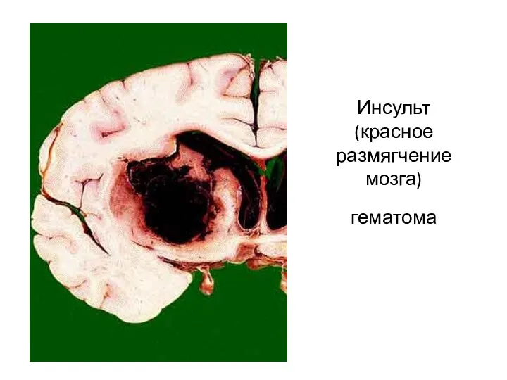 Инсульт (красное размягчение мозга) гематома