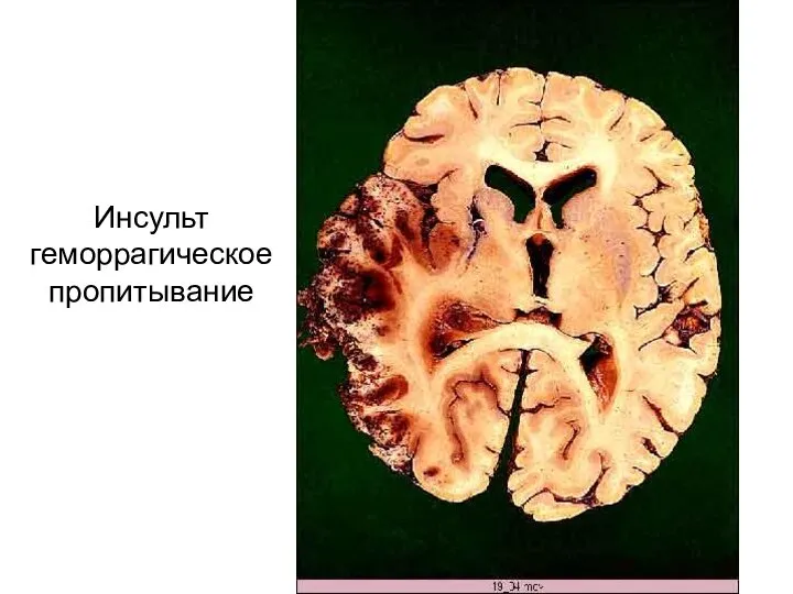 Инсульт геморрагическое пропитывание