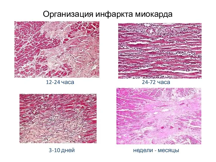 Организация инфаркта миокарда 12-24 часа 24-72 часа 3-10 дней недели - месяцы