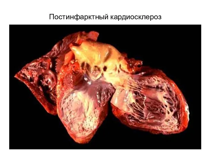 Постинфарктный кардиосклероз