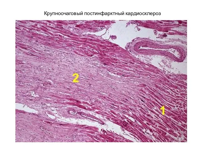 Крупноочаговый постинфарктный кардиосклероз