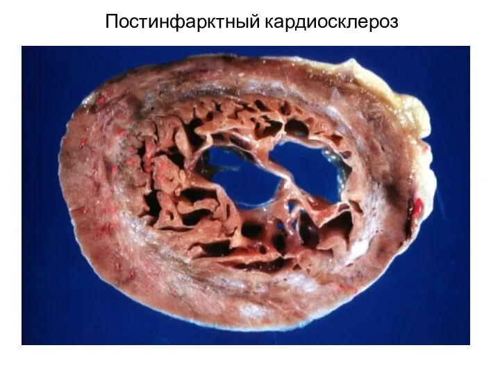 Постинфарктный кардиосклероз