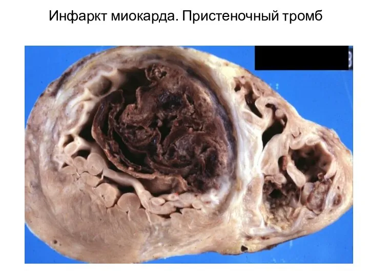 Инфаркт миокарда. Пристеночный тромб