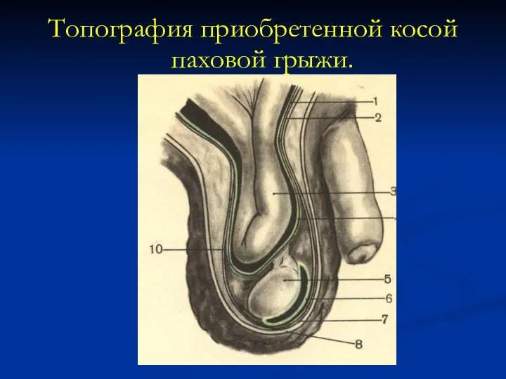 Топография приобретенной косой паховой грыжи.