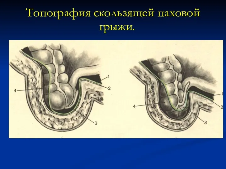 Топография скользящей паховой грыжи.